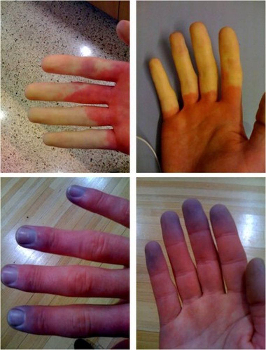 <p>Raynaud phenomenon - vasoconstrictive event triggered by emotional stress or cold</p>