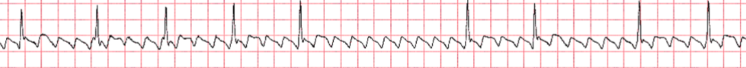 <p>saw tooth flutter waves, narrow QRS </p>