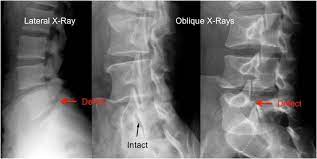 <p>cleft in the pars interarticularis without displacement. Usually bilateral. most common at L5.</p>