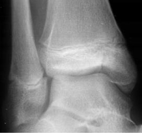 <p>what type of salter Harris fracture is this? what kind of tx is needed?</p>