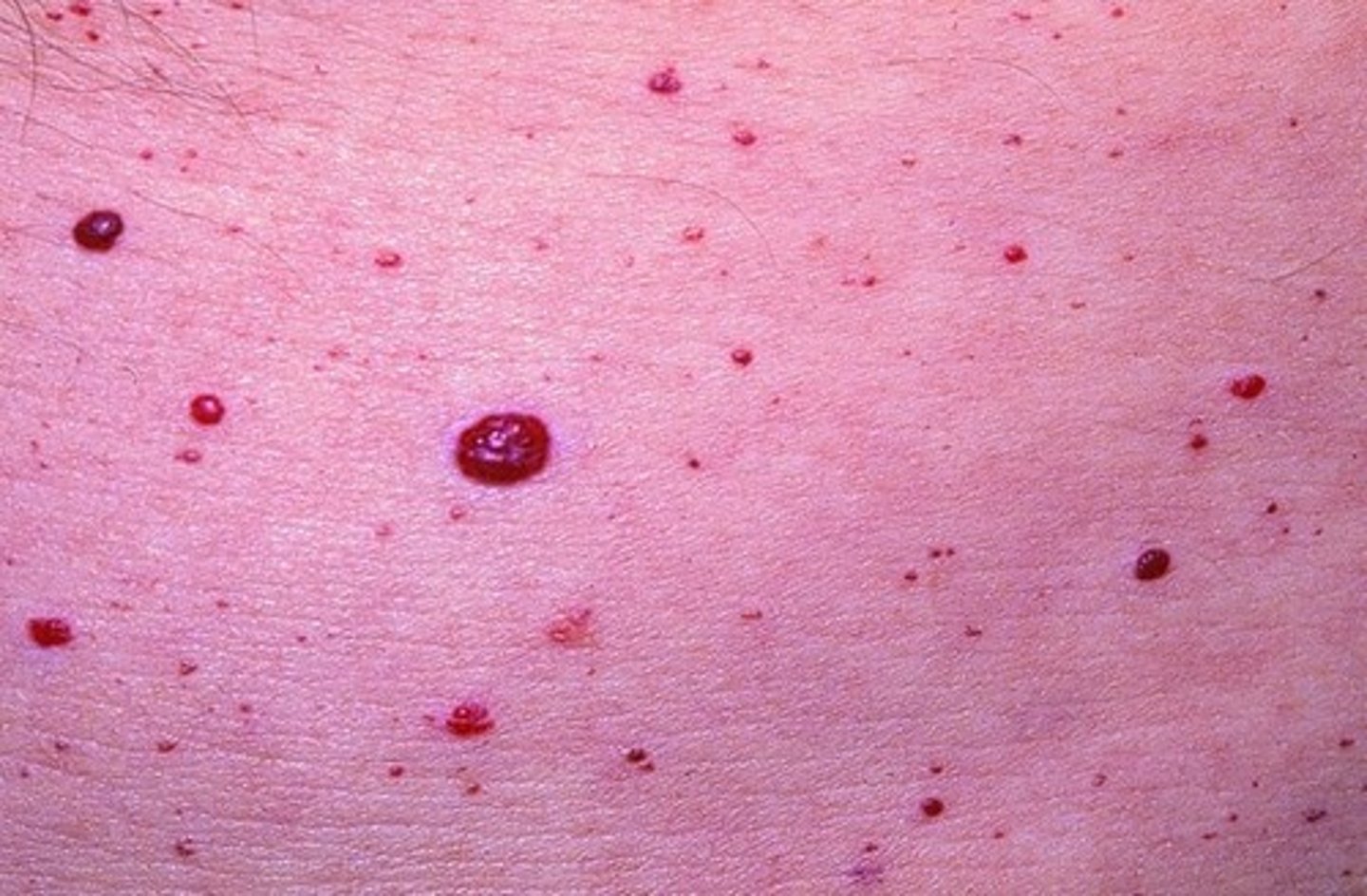 <p>a small, round, bright red blood vessel tumor on the skin, often on the trunk of the elderly</p>