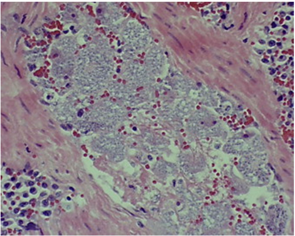 <p>This picture is showing schizont infected macrophages in a splenic blood vessel from a positive case of what?</p>