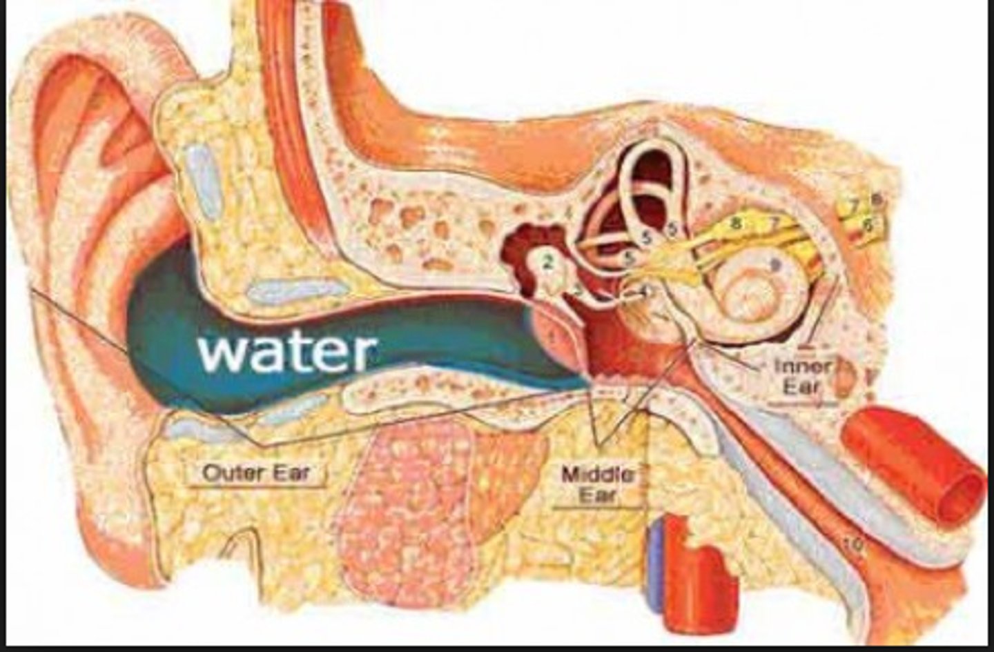 <p>CA: Pseudomonas aeruginosa /Staphylococcus aureus<br>MOT: - contaminated water enters ear<br>Si/Sx: -ear inflammation -muffled/loss hearing -extreme pain<br>Dx: -Hx -PE<br>Tx: -topical ABX / ear drops (ciprofloxacin, hydrocortisone)</p>