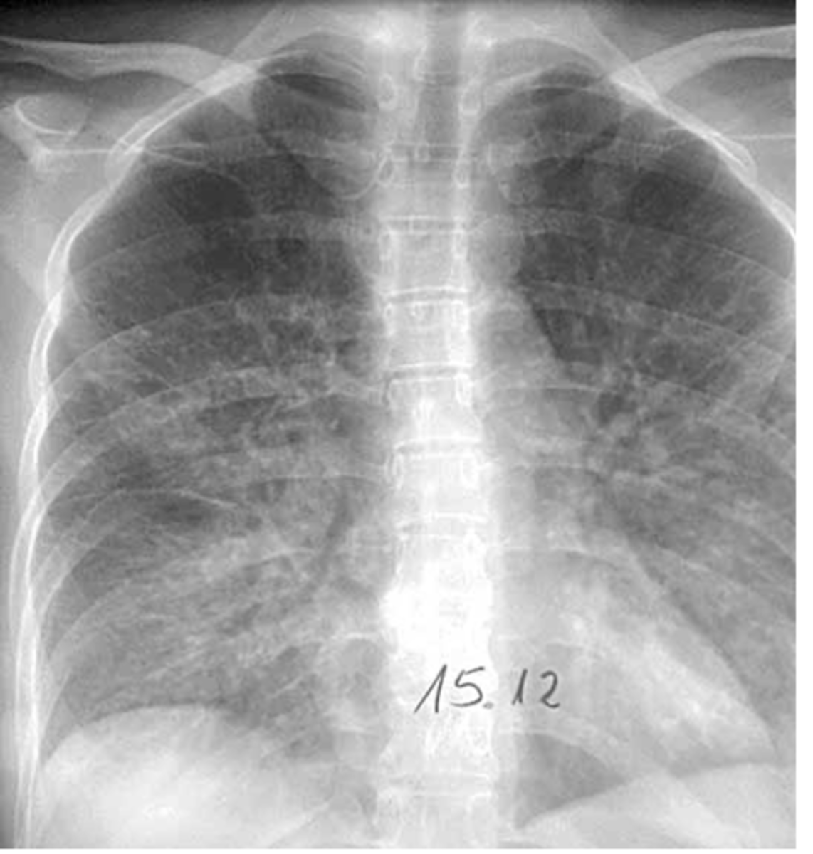 <p>- non specific....but CHF, pulmonary fibrosis, collagen vascular diseases, etc.</p>