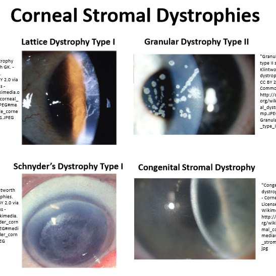 <p>Lattice Dystrophy Type 1</p><p>Granular Dystrophy Type 2</p><p>Schnyder’s Dystrophy Type 1</p><p>Congenital Stromal Dystrophy</p>