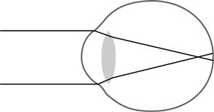 <p>This figure shows the focal point of light rays in an eye that is which of the following?</p><p></p><p>A) Myopic</p><p class="MsoNormal">B) Presbyopic</p><p class="MsoNormal">C) Emmetropic</p><p><span style="font-family: Aptos, sans-serif">D) Hyperopic</span></p>