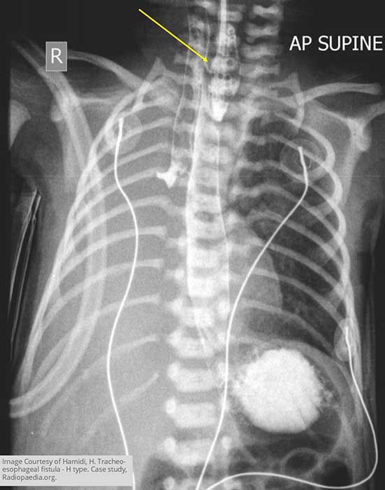 <p>What does abdominal gas pattern indicate in TEF?</p>