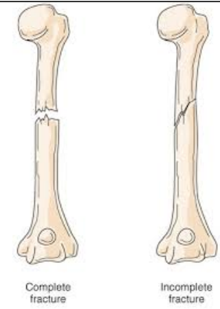 <p>Fractures are classified by the degree and pattern of breakage into two main types:</p><ul><li><p><strong>Incomplete fractures</strong> (partial breaks)</p></li><li><p><strong>Complete fractures</strong> (bone fully separated)</p></li></ul><p></p>
