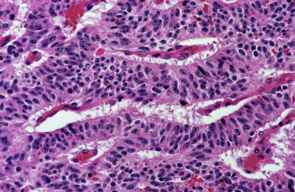 <p>lung small cell or carcinoid tumors are more pink = more cytoplasm?</p>