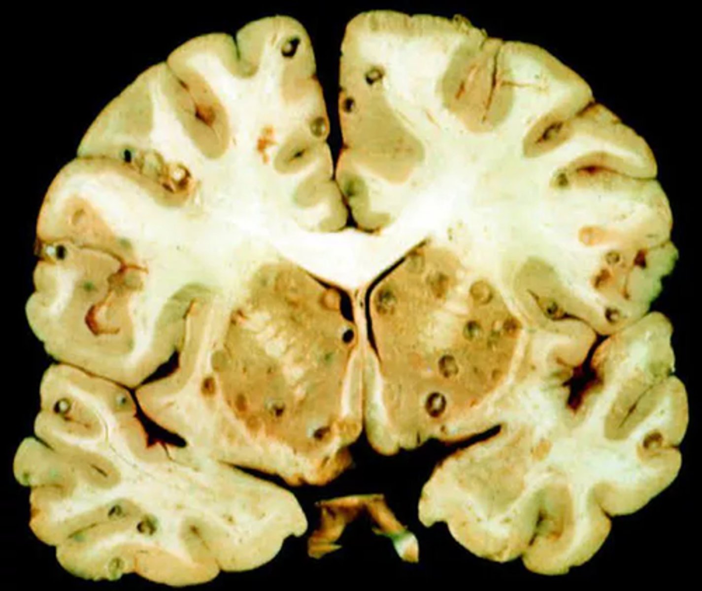 <p>How do humans acquire the zoonotic disease neurocysticercosis associated with the Pork Tapeworm, Taenia solium?</p>