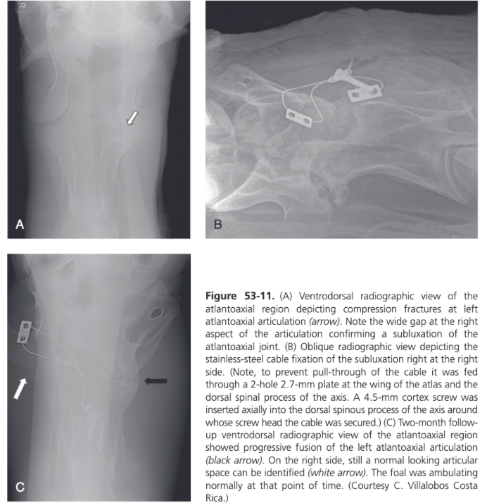 <ul><li><p><span>Surgery is recommended in horses showing neurologic deterioration or persistence of neurologic deficits despite conservative treatment</span></p><ul><li><p><span>Can be successfully treated with subtotal dorsal laminectomy</span></p><ul><li><p><span>Removal of the caudal two thirds of the dorsal arch of the atlas relieves spinal cord compression and allows preservation of the normal range of motion of the atlantoaxial articulation</span></p></li><li><p><span>A portion of the dorsal atlantoaxial ligament is left intact</span></p></li><li><p><span>Spinal cord compression may be resolved but persistent instability represents a potential threat for several weeks after surgery</span></p></li><li><p><span>In one report of four horses with atlantoaxial subluxation treated with dorsal laminectomy, two horses recovered completely and a third showed satisfactory improvement, one was lost to follow up (Nixon and Stashak, 1988)</span></p></li></ul></li></ul></li><li><p><span>No surgical treatment has been reported for complete atlantoaxial luxation</span></p></li><li><p><span>Arthrodesis with plates is indicated in horses with a chronic atlantoaxial (C1 to C2) subluxation accompanied by neurologic signs</span></p><ul><li><p><span>Dorsal recumbency with the head extended</span></p></li><li><p><span>Custom-made wedges are used to stabilize the neck in a sagittal position with accurate alignment of vertebrae C2 and C3</span></p></li><li><p><span>Ventral midline approach</span></p></li><li><p><span>Human distal femur plate can be used</span></p><ul><li><p><span>Advantage is that it allow several cortex or locking head screws to be placed through the head of the plate</span></p></li></ul></li></ul></li><li><p><span>In selected cases, an unconventional fixation technique can be helpful</span></p><ul><li><p><span>7 month old foal suffering from a left-sided atlantoaxial compression fracture that occurred 3 weeks earlier and led to progressing signs of ataxia</span></p></li><li><p><span>Instability was supported with the help of a stainless steel cable fed through a small 2.7 mm 2 hole plate at the right-wing of the atlas and an identical plate at the right side of the dorsal spinous process of the axis</span></p></li><li><p><span>Foal was recumbent for 1 week post-op but then recovered to a normal gait</span></p></li><li><p><span>2 month follow-up radiographs showed beginning fusion of the left atlantoaxial joint space</span></p></li></ul></li></ul>