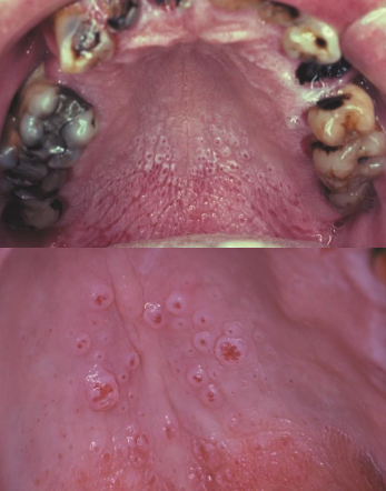 <p>what condition is a leathery, white change of the hard palatal mucosa in long term smokers?</p>