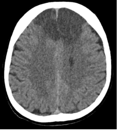 <p>Anterior cerebral artery (ACA) Obstruction</p>