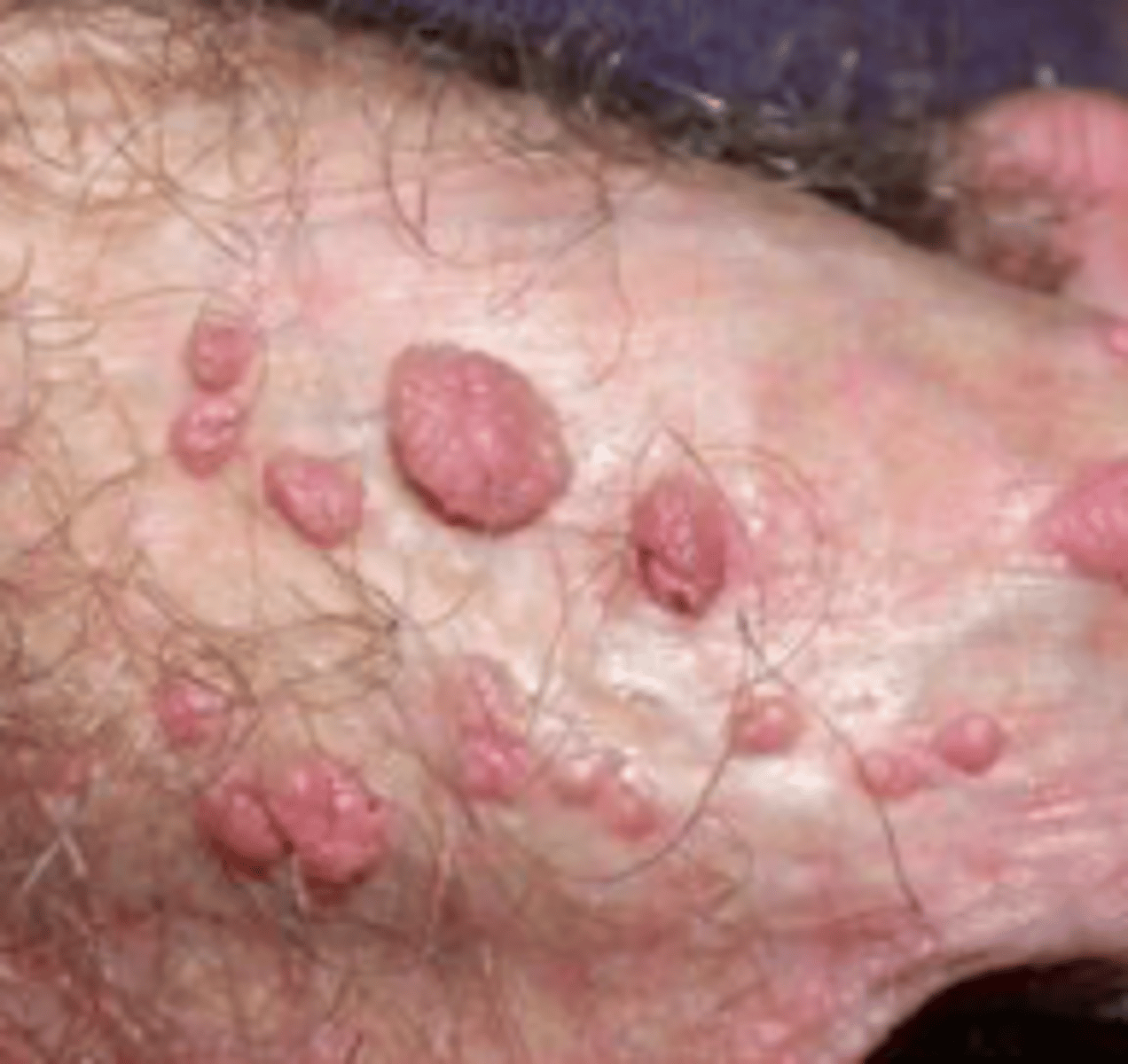 <p>Viral Skin Infections:</p><p>aka <strong>genital warts</strong></p><p>- caused by <strong>HPV 6 and 11</strong></p><p>- small papules that are "<strong>cauliflower-like</strong>"</p><p>- keratotic, flat-topped, skin-colored to pink</p><p>- can be solitary or clustered</p><p>prevented by using condoms and getting PAP smears yearly</p>