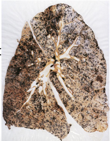 <ul><li><p>black lung disease</p></li><li><p>increase carbon particles of impurities</p></li><li><p>dust accumulates and incites fibrotics</p></li></ul><p></p>