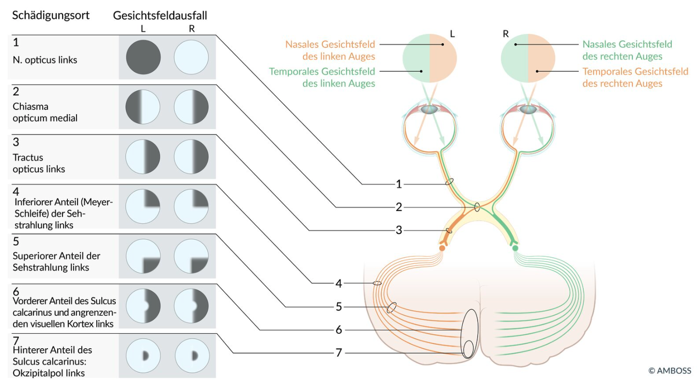 <p>A. Impairment of the right visual field</p>
