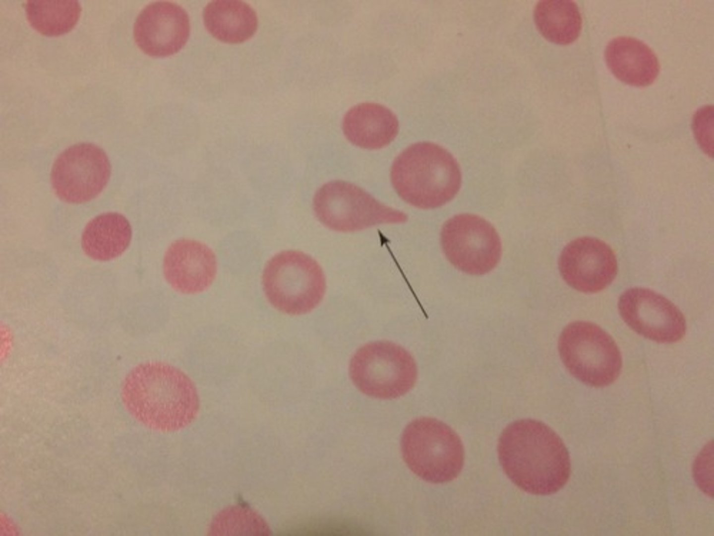 <p>Round cell with a single, elongated or pointed extremity; may be microcytic and/or hypochromic</p>