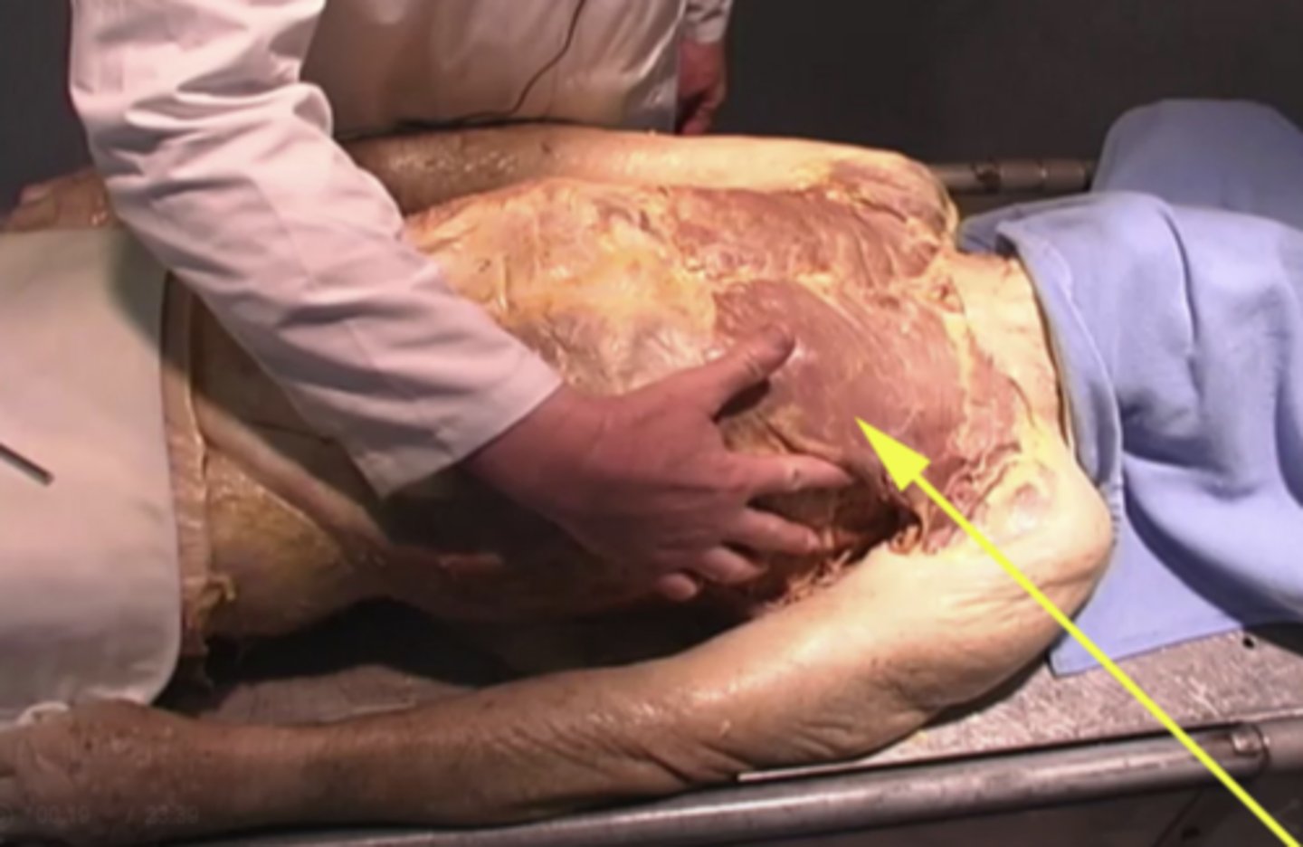 <p>What is the structure being shown here?</p><p>pectoralis major</p><p>inferior margin of the muscle</p><p>spine</p><p>sternum</p>