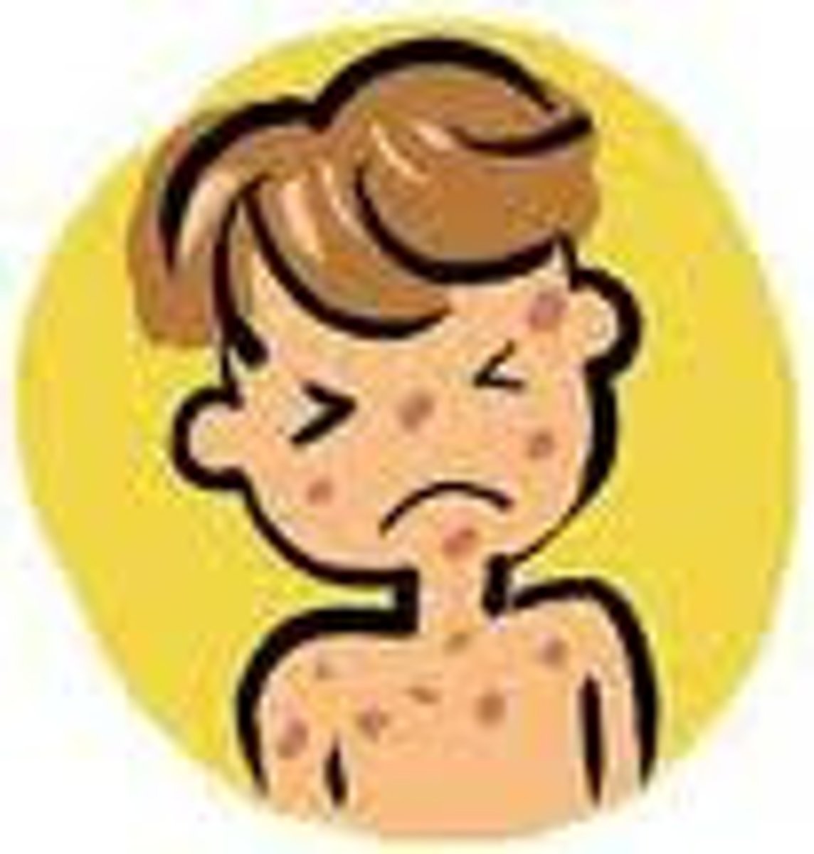 <p>rash</p>