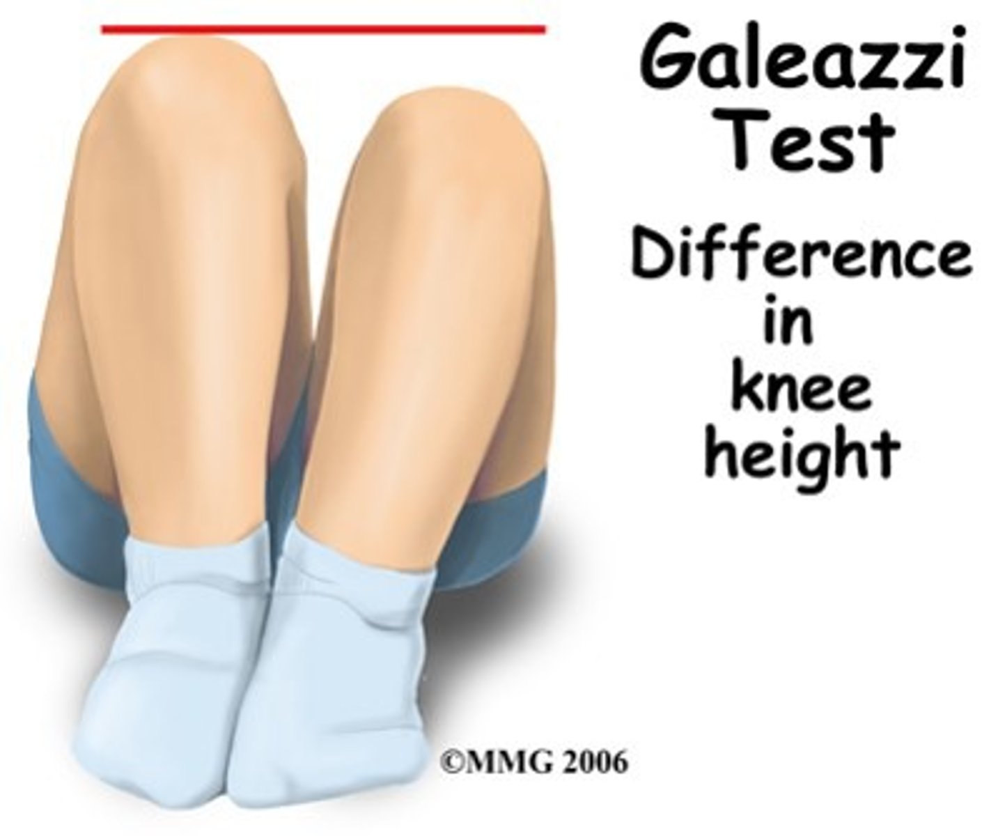 <p>when the pt is supine with knees flexed and dislocation can be seen if one knee is lower than the other</p>