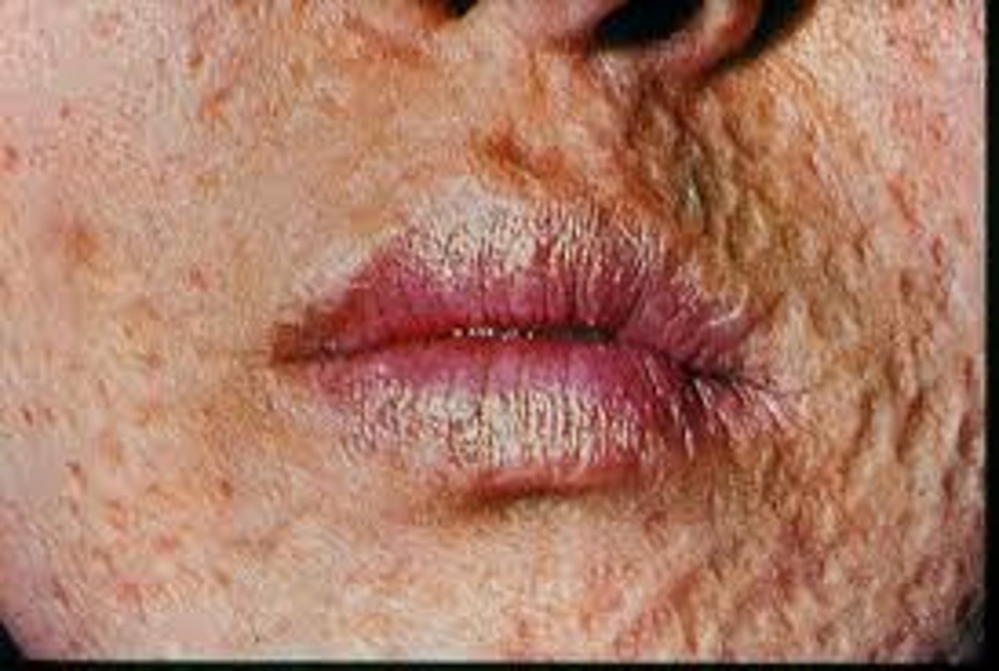 <p>a small hollow on your skin that is left after a spot caused by a disease, such as chickenpox or smallpox, has healed</p>