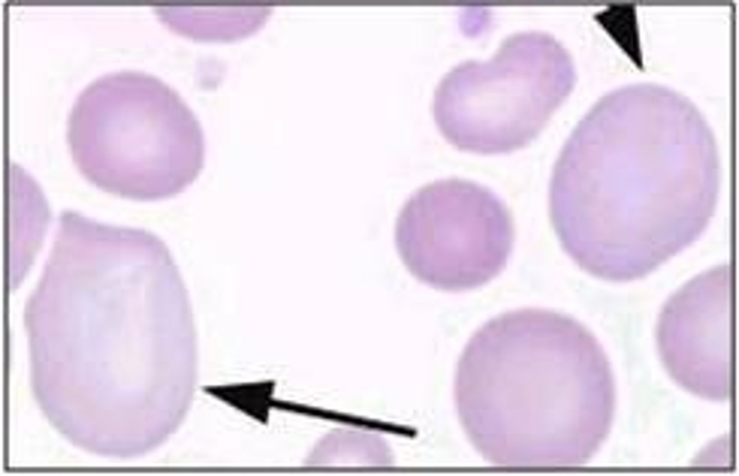 <p>Anemia characterized by large RBCs (caused by B12 or Folic Acid deficiency)</p>
