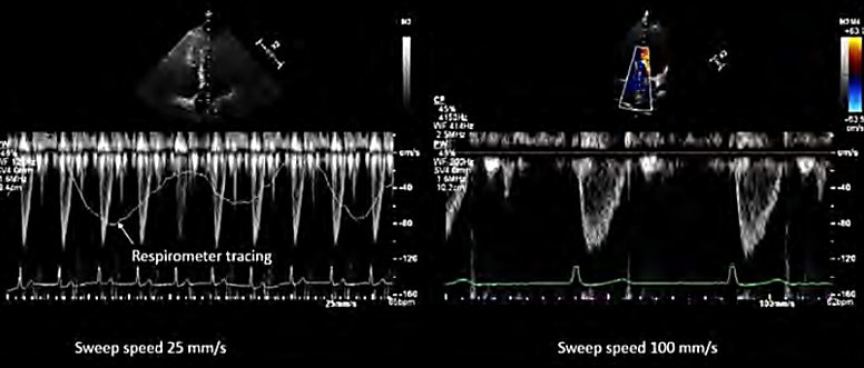 <p><strong># of cardiac cycles shown</strong></p><p>(100mm/sec)</p>