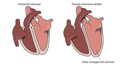 <p><strong>Effect of increased left ventricle size</strong></p>