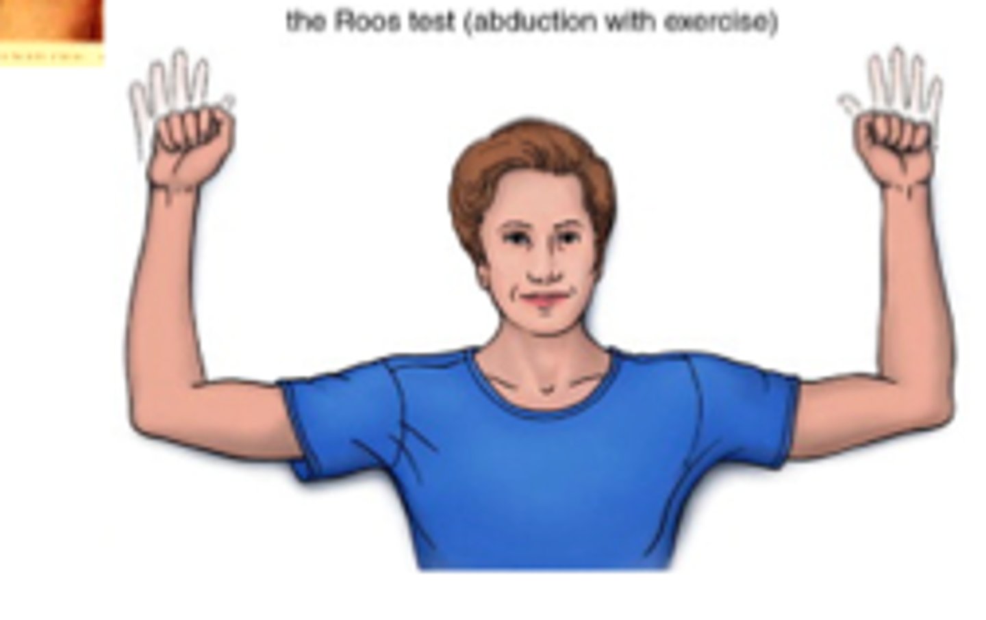 <p>Thoracic outlet syndrome</p><p>-pt sitting with arms fully ER and 90 abducted, slight horizontal abduction and elbows flexed to 90</p><p>-PT instructs patient to open and close hands for 3 mins slowly</p><p>-neuro/vascular symptoms reproduced in UE</p>