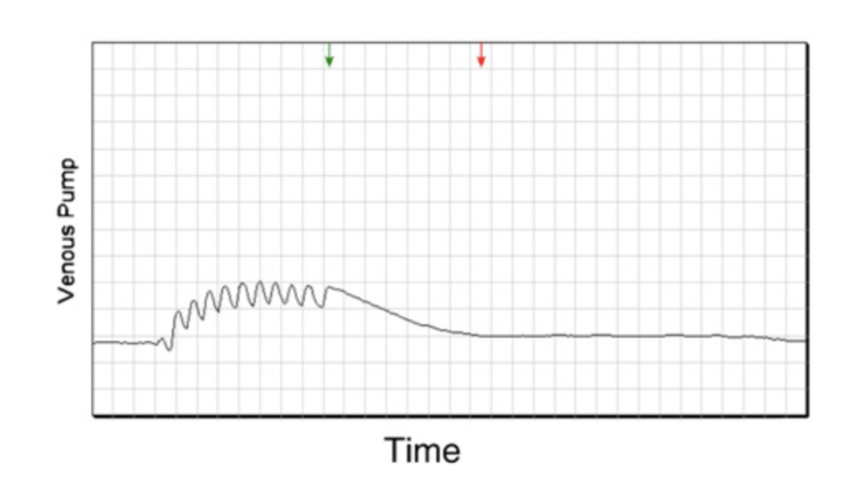 <p>Can use PPG probes to determine venous refill time (VRT)</p><p>• PPG is a measure of volume of blood flow in tissue (Less commonly used)</p><p>Place probe on distal GSV at medial malleolus and have patient perform dorsi flexion</p><p> Amount of time for veins to refill recorded ( image of a normal refill time is shown on term, abnormal is shown on definition card)</p><p>• Venous Refill Time Criteria:</p><p>– Normal &gt;40 seconds</p><p>– Borderline 20-40 seconds</p><p>– Abnormal &lt;20 seconds</p>