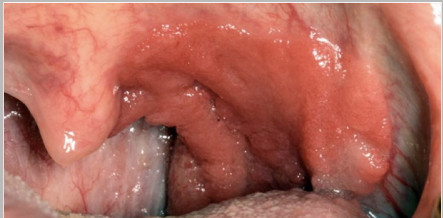 <p>What is the treatment for HPV+OSCC?</p>