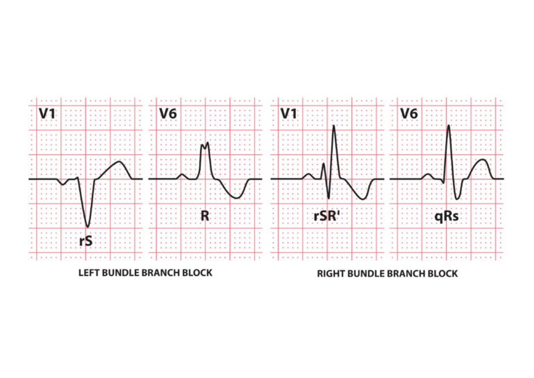 <p>What does this refer to</p><p>“________ carry the signal from just below the AV node (the junction between the top and bottom chambers of the heart) through the ventricles (bottom of the heart).”</p>