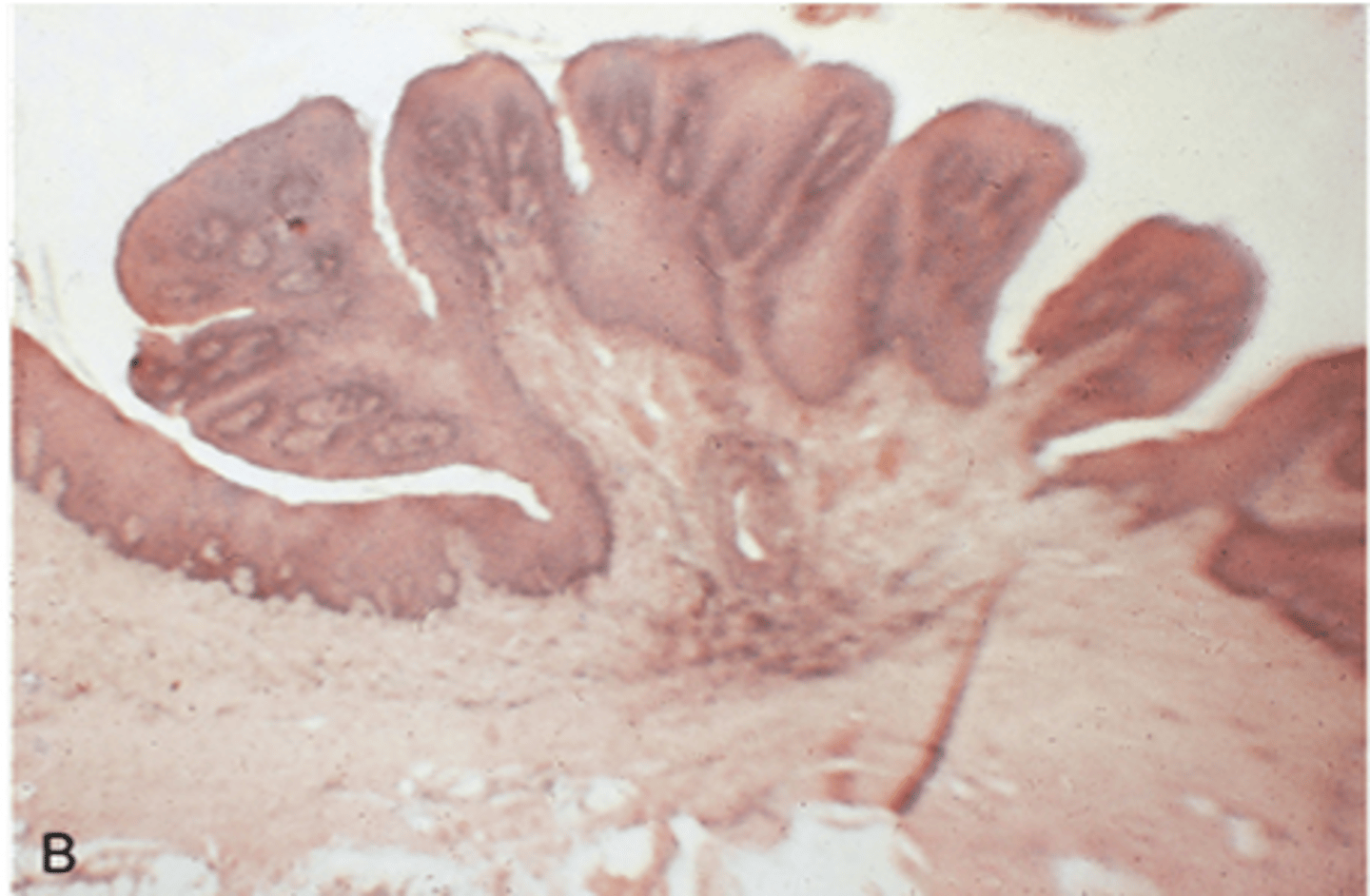 <p>-microscopic appearance of a papiloma shows fingerlike projections surfaced by squamous epithelium and supported by thin cores of fibrous connective tissues</p><p>-a central core of vascular fibrous connective tissue supports each papillary projection</p>