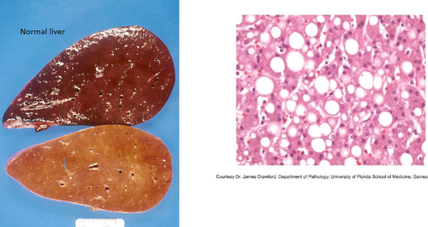 <p>Excessive lipid accumulation in hepatocytes</p>