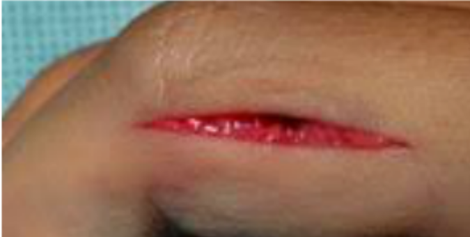 <p><strong>1. VULNUS SCISSUM </strong></p><p></p><p>Incisions/ scalpel/ knife/ surgical wound</p><p></p><ul><li><p> Regular, straight edges come to a point </p></li><li><p>length is greater than the depth-  slash not stab</p></li><li><p>clean margins, easier surgical closures </p></li></ul><p></p><p></p><p><strong>• (1°) Primary  Healing </strong></p><ul><li><p>oppose separated edges (suture/strips/glue)  </p></li><li><p>minimal scarring</p></li><li><p>faster recovery </p><p></p></li></ul><p>• Can cut through tendons, vessels, nerves</p><ul><li><p>functio leasa = (loss of function)</p><p></p></li></ul><p>• BLEEDING</p><ul><li><p>Due to clean-cut <strong>transection of blood vessels</strong>.</p></li></ul><p></p>