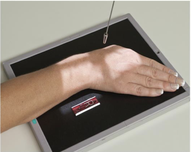 <p><span style="line-height: normal;"> </span>Patient is positioned same as PA wrist except hand is flat on IR</p><p class="p1"><span style="line-height: normal;"> </span>Wrist is in ulnar deviation</p><ul><li><p class="p1"><span style="line-height: normal;"> </span>Forearm remains stationary</p></li><li><p class="p1"><span style="line-height: normal;"> </span>Hand is deviated towards the ulna</p></li><li><p class="p1"><span style="line-height: normal;"> </span>1<span style="line-height: normal;">st </span>metacarpal is aligned w/ radius</p></li></ul><p class="p1"><span style="line-height: normal;"> </span>CR centered to scaphoid</p><ul><li><p class="p1"><span style="line-height: normal;"> </span>2cm distal &amp; medial to radial styloid process</p></li></ul><p class="p1"><span style="line-height: normal;">                   - </span>Base of anatomical “snuff box”</p><p class="p1"><span style="line-height: normal;"> </span>Collimation can be closer than for “regular” PA wrist</p><p class="p1"><span style="line-height: normal;"> </span>CR may be angled toward the elbow</p><ul><li><p class="p1"><span style="line-height: normal;"> </span>10-15<span style="line-height: normal;"> o </span>or 20° (Stetcher Method)</p></li></ul><p class="p1"></p><p class="p1">Other Positioning Modifications for Scaphoid</p><ul><li><p class="p1"><span style="line-height: normal;"> </span>Clenched fist (done at QEH, make fist to straighten scaphoid, and ulnar deviate)</p></li><li><p class="p1"><span style="line-height: normal;"> </span>Elevated Hand/Wrist</p></li><li><p class="p1"><span style="line-height: normal;"> </span>Multiple CR angles</p></li></ul><p></p>