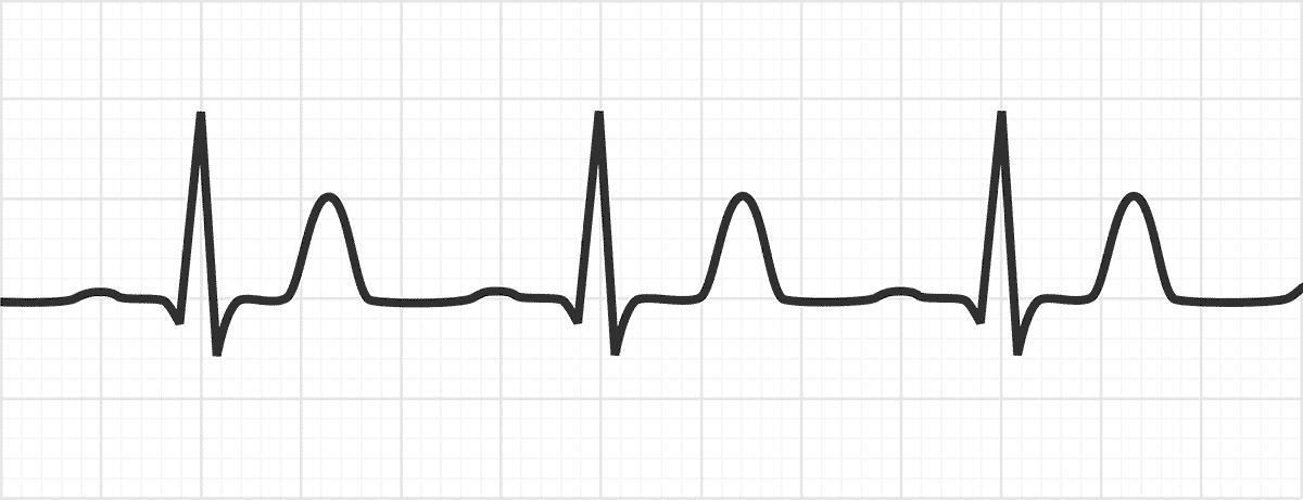 <p>c) tall peaked T waves</p><p>e) widened QRS complexes</p>