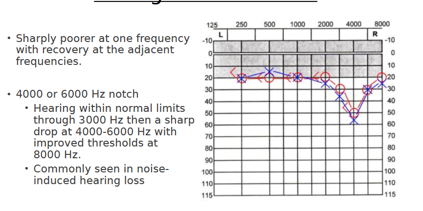 <p>“Normal-mild hearing with a notch”</p>