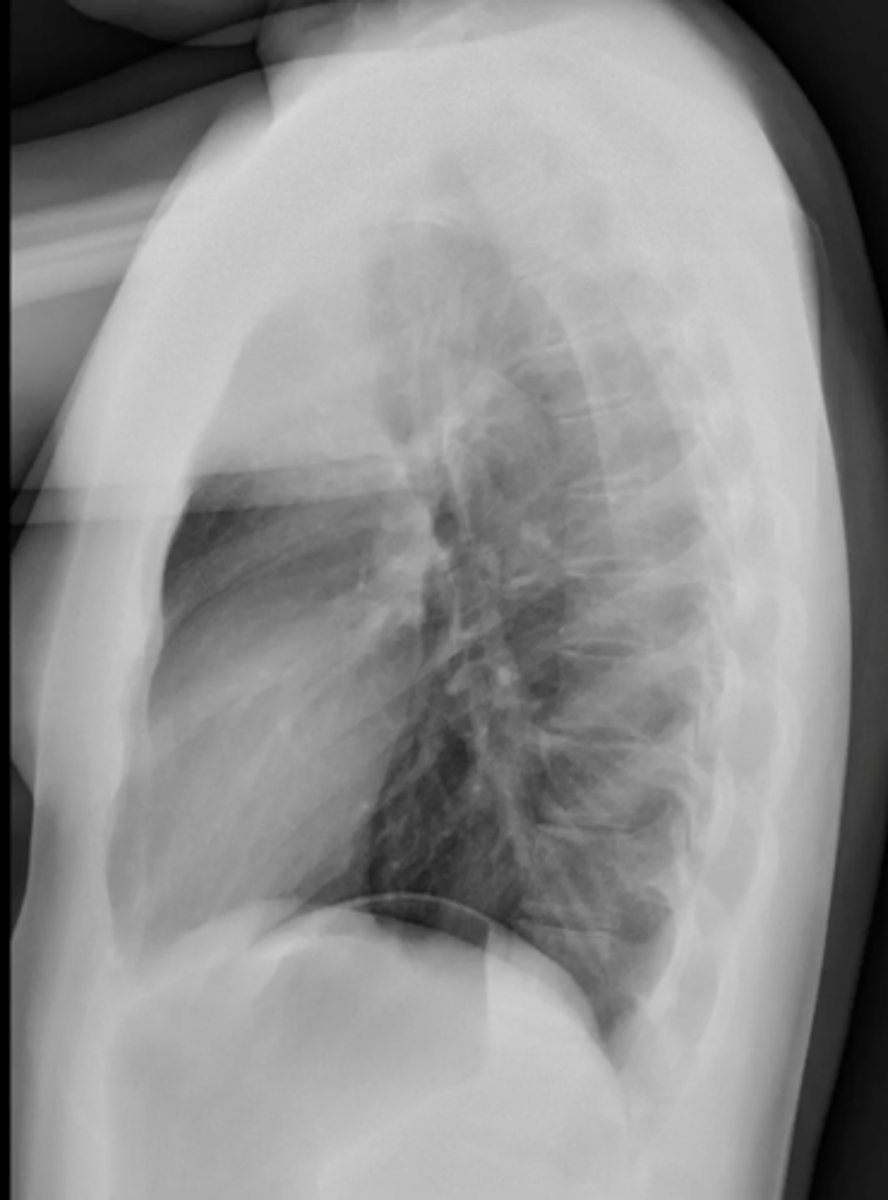 <p>(evaluating Lateral CXR)</p><p>exposure</p>