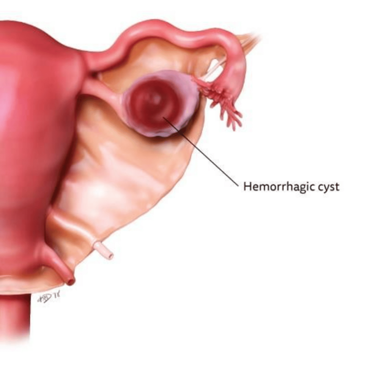 <p>A 'fishnet' or 'cobweb' reticular pattern (fibrin strands) or a variable solid appearance.</p>