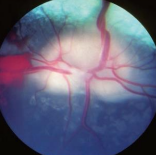 <p><span>Vitamin A Deficiency</span></p>