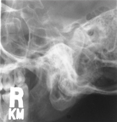 <p>What is this x-ray demonstrating?</p>
