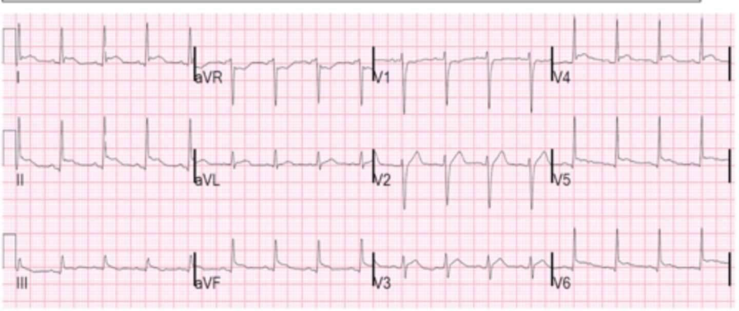 <p>Pericarditis</p><p>**Does not meet STEMI criteria</p>