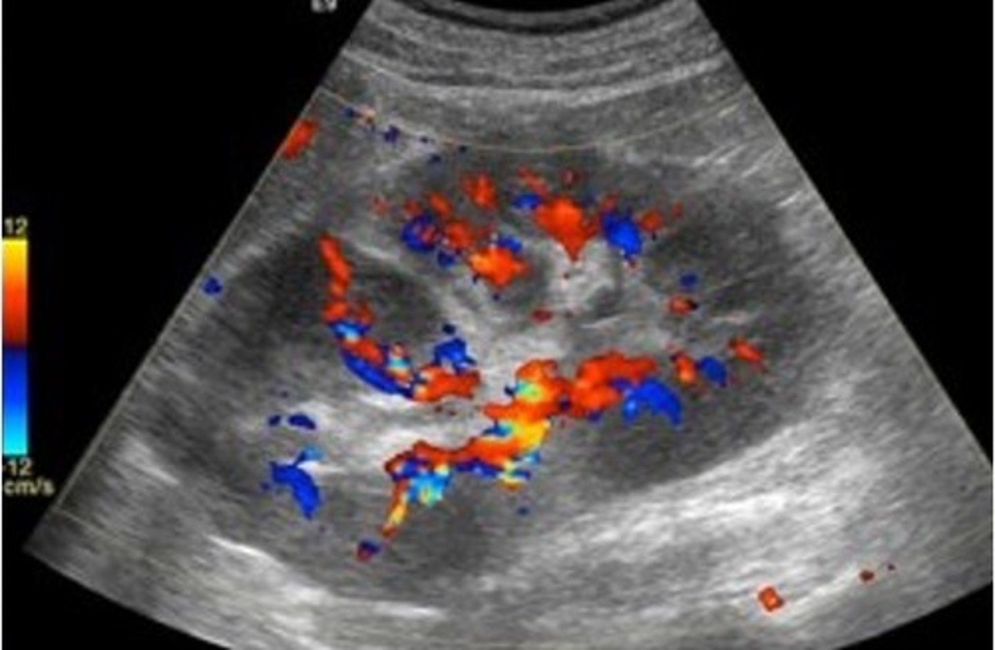 <p>Non-Hodgkin lymphoma</p>