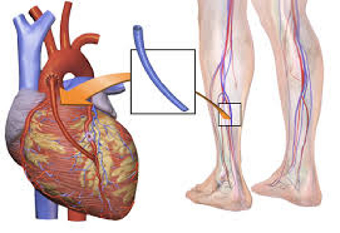 <p>-diseased section of coronary arteries is bypassed with healthy blood vessels to improve coronary circulation (sx procedure)</p><p>-performed when lesion is too loose or if an artery reoccludes after PTCA</p><p>a sternotomy is performed to access the heart for a CABG (leads to sternal precautions post-sx)</p>