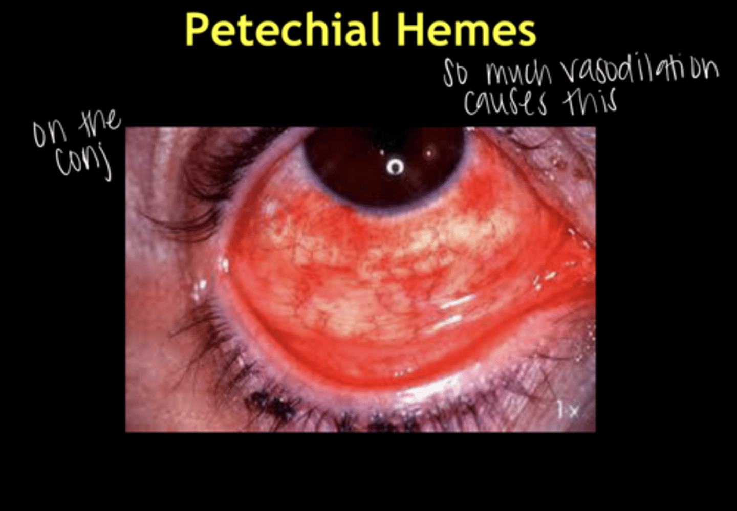 <p>What is the cause of petechial hemes on the conj in patients with EKC?</p>
