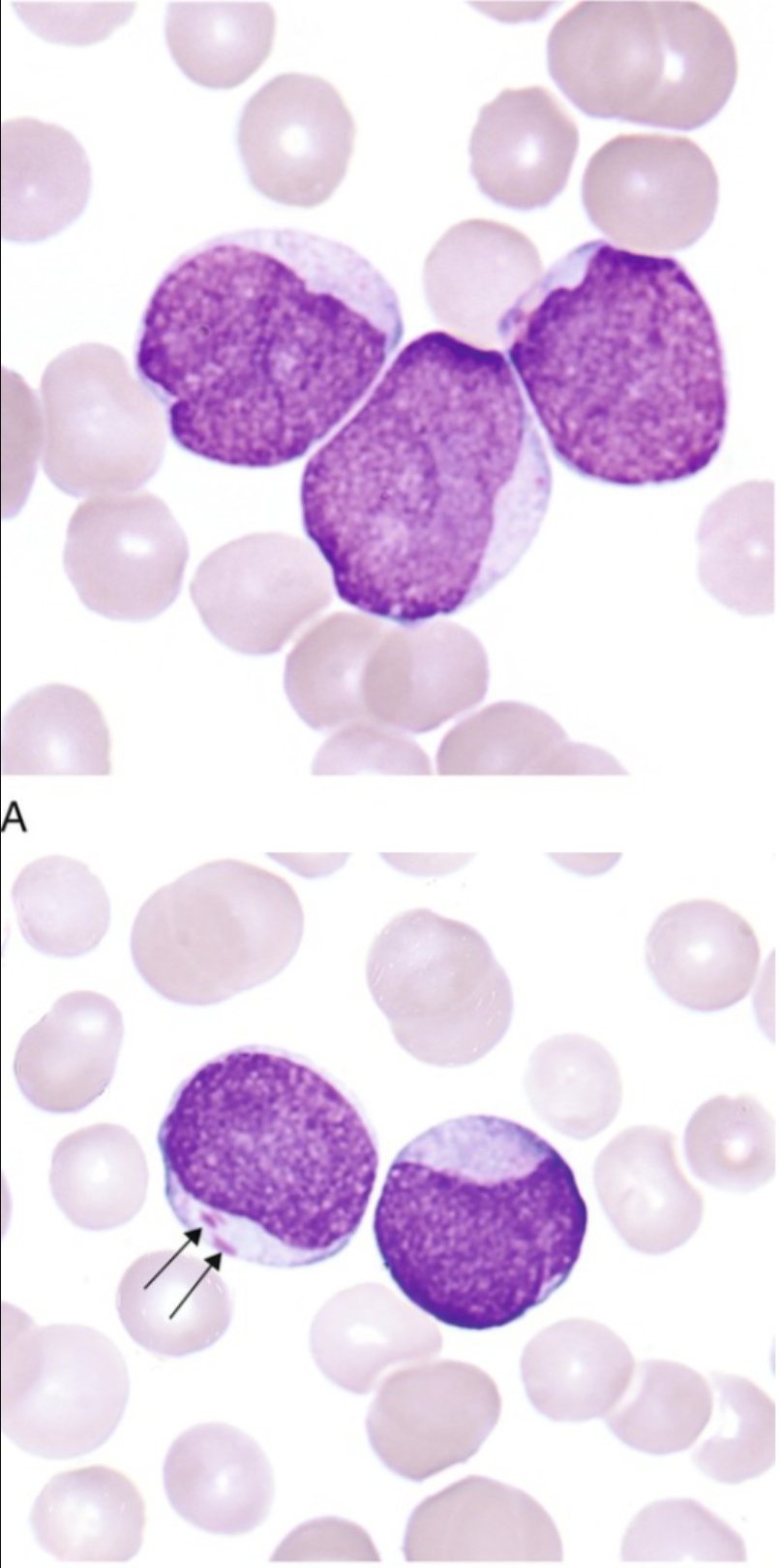 <ul><li><p>Seen in young to middle age adults</p></li><li><p><strong> Predominant cell myeloblast, +/- auer rods</strong></p></li><li><p> Frequency 10%</p></li><li><p> MPO+, SBB+, CAE+</p></li><li><p><strong> CD13, CD33</strong> myeloid markers</p></li><li><p> High WBC count</p></li><li><p> Poor Prognosis</p></li></ul><p></p>