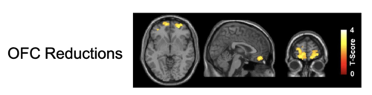 <p>- Structural MRI studies: regularity and/or duration of cannabis use, as well as the severity of CUD where relevant, are related to lower gray matter volumes of the orbitofrontal cortex (OFC), temporal lobe, hippocampus, and amygdala</p><p>- altered volume might reflect changes in dendritic arborization and/or synaptic connectivity.</p><p>- cannabis-related gray matter reductions could be a result of withdrawal of dendritic arbors and an accompanying decrease in the number of synapses in the affected areas</p><p>- Marijuana smoking can also adversely affect the cardiovascular and cerebrovascular systems&gt;&gt;associated with increased risk for atrial fibrillation, ventricular arrhythmias, heart attack and sudden cardiac death</p>