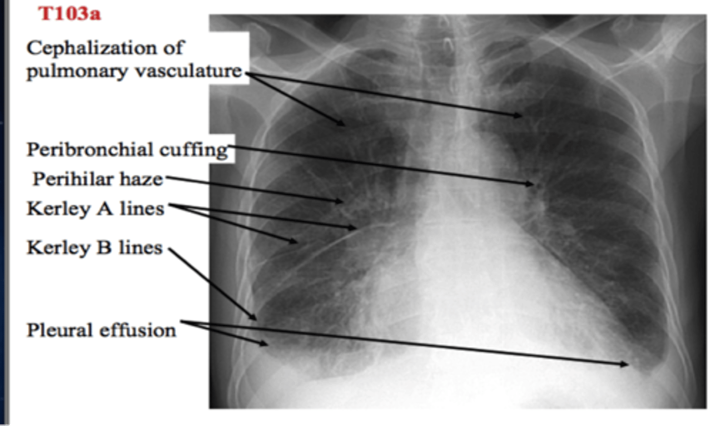 <p>-kerley lines</p><p>-pleural effusion</p><p>-peribronchial cuffing</p><p>-hydrostatic intersitital edema</p>