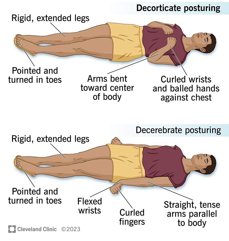 <ol><li><p>Decorticate posturing </p></li><li><p>Decerebrate posturing</p></li></ol><p></p>